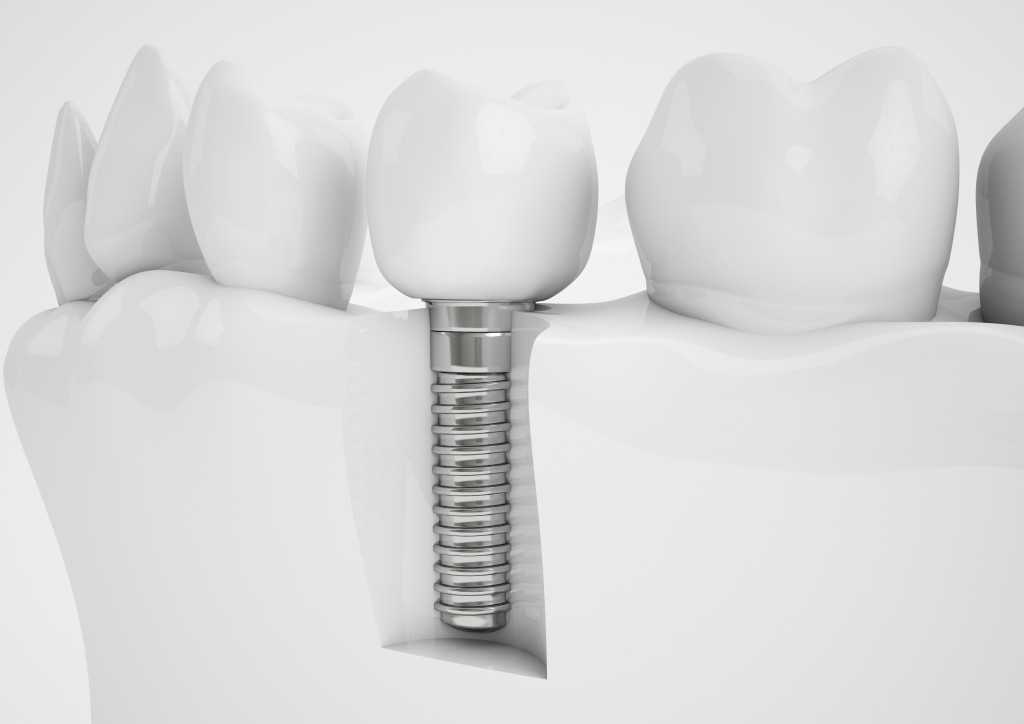 Dental implants model
