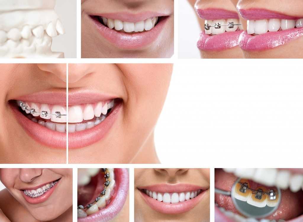 Difference of Traditional and Incognito Lingual Braces