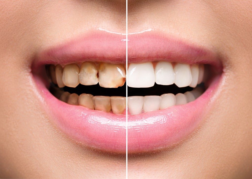 Woman's teeth before and after treatment