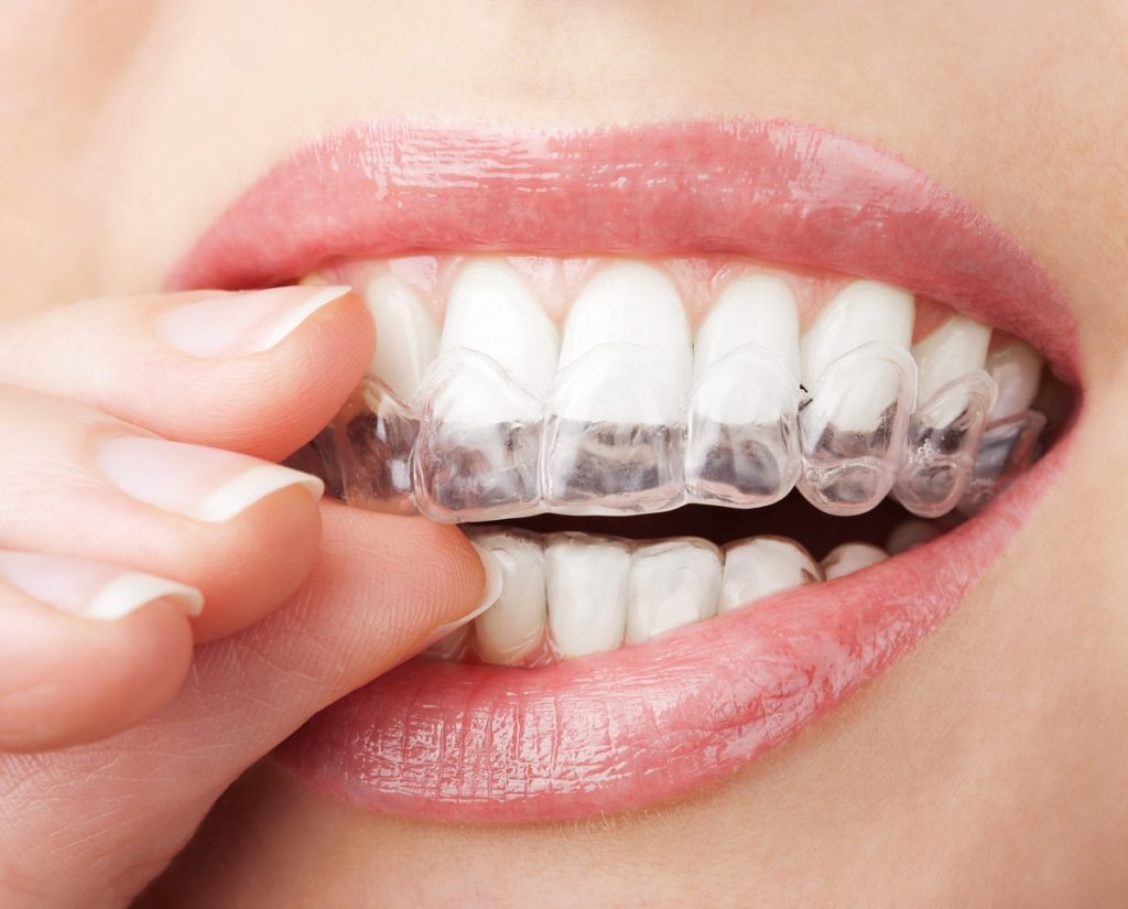 Woman about to wear her invisible braces