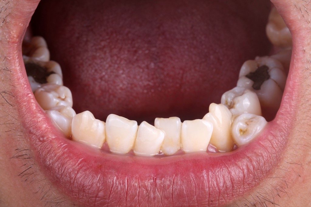 person with crooked teeth and cavities